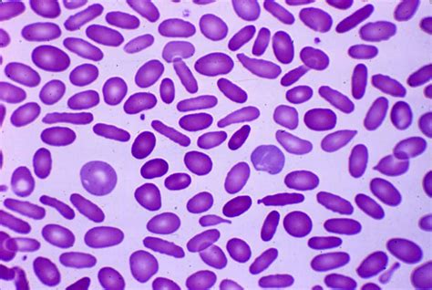 Hereditary elliptocytosis .